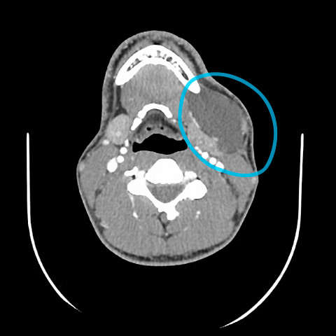 CT neck ranula