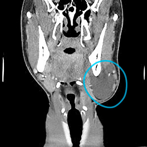 CT neck ranula CT neck ranula