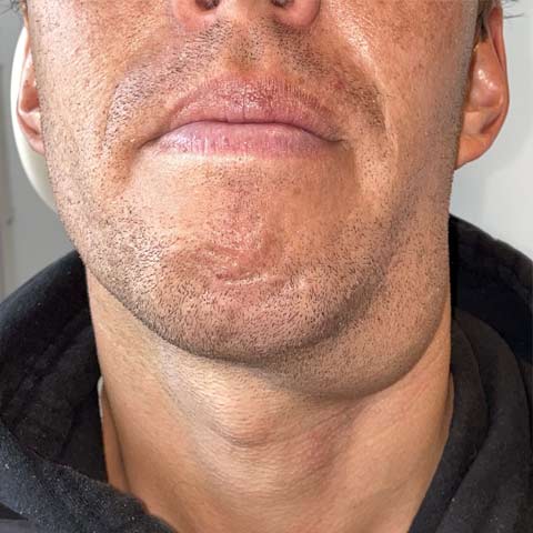Ranula